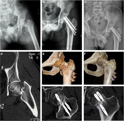 Treatment of postoperative non-union with internal fixation loosening of Garden IV femoral neck fracture with teriparatide in a young adult: A case report